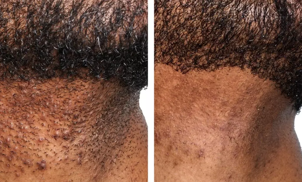 One or Two Laser Skin Resurfacing Sessions for Full Face & More 