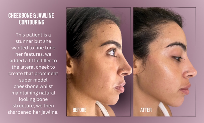 Image 2: Up to 38% Off on Injection - Dermal Filler at Divine Aesthetics Clinic London