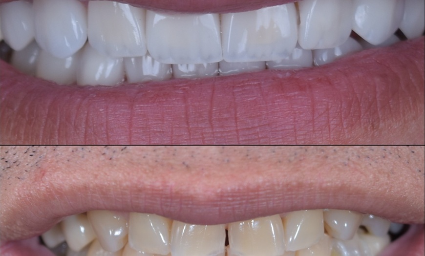 Image 4: Dental Crowns, Dental Exam, X-rays & Cleaning, Dentures & More