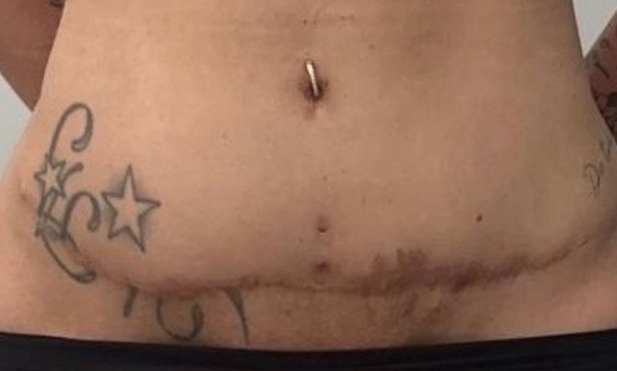 Image 6: Inkless Paramedical Tattoo for Stretch Marks and Scars