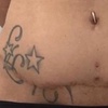 Image 6: Inkless Paramedical Tattoo for Stretch Marks and Scars
