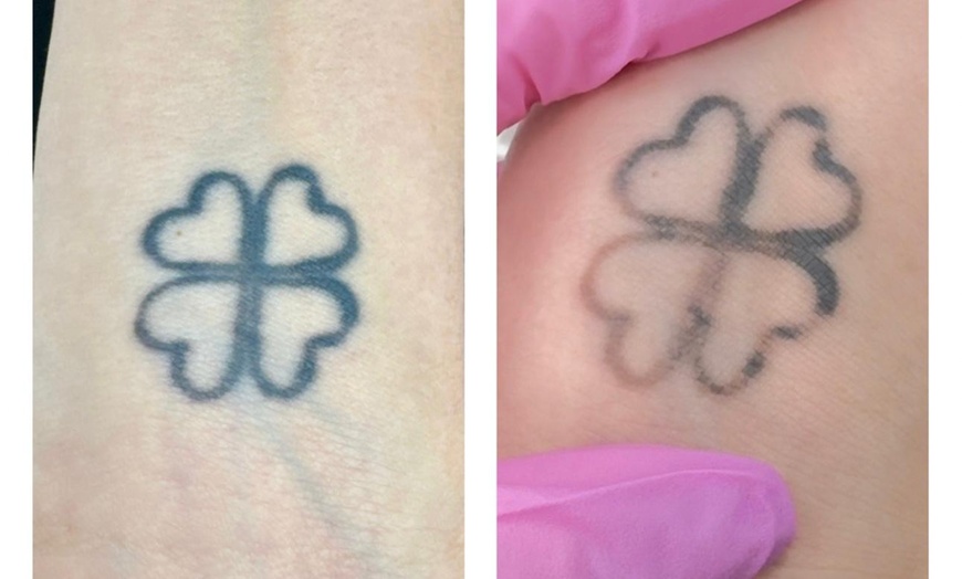 Image 4: Up to 68% Off on Tattoo Removal at HL Lasers