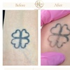 Image 4: Up to 68% Off on Tattoo Removal at HL Lasers