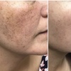 Image 6: CO₂ (Fair Skin Only) or Pico (Most Skin Types) Laser Treatment at A+