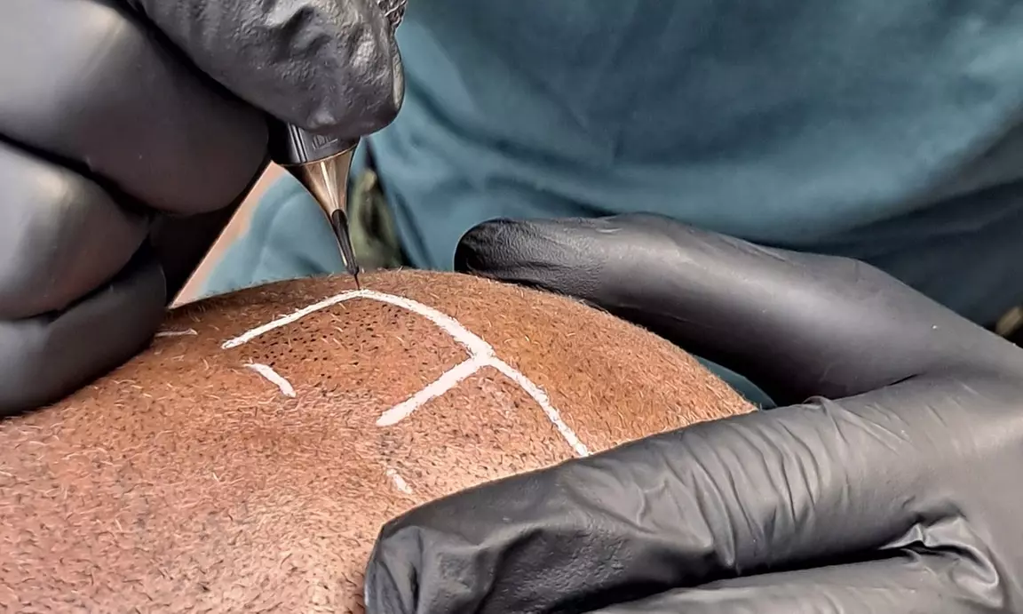 Up to 37% Off on Scalp Micro-pigmentation Hair Loss Treatment