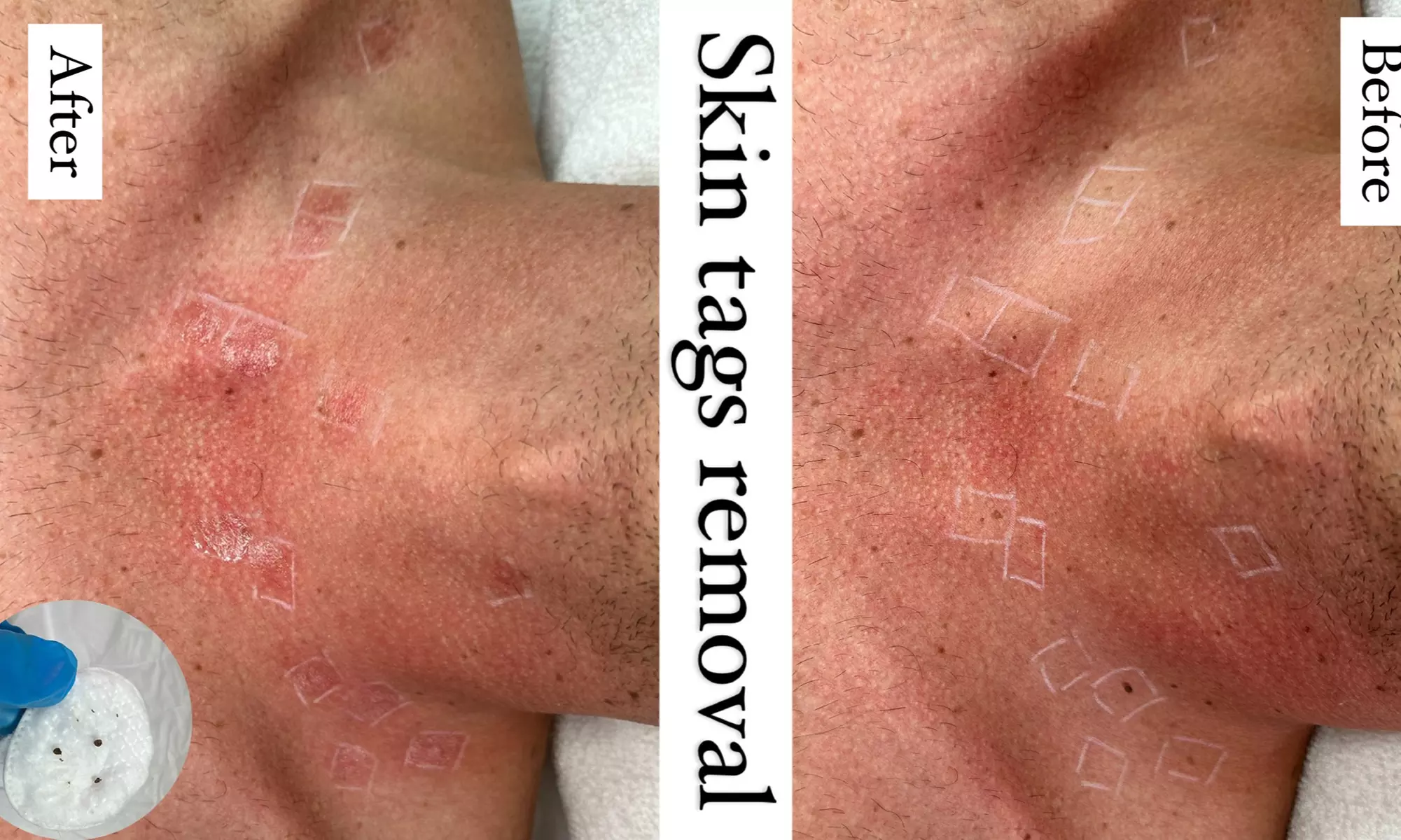 Remove Up To 10 Skin Tags, Moles, Warts Or Milia Up To 2mm