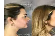 Enhance Your Looks with Juvederm Cheek Filler at River Oaks Galleria Medspa (Up to 45% Off) - Second Medium