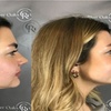Image 3: Enhance Your Looks with Cheek Filler
