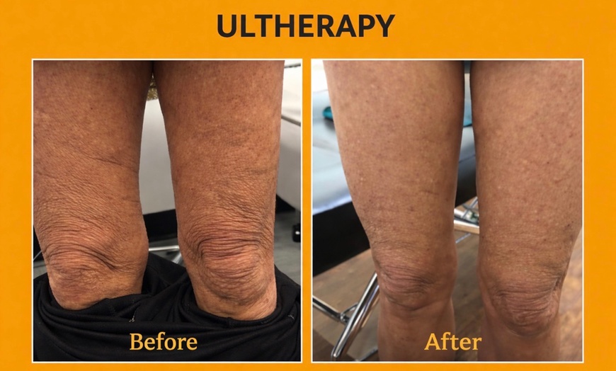 Image 6: Ultherapy Prime Treatment with for Face, Neck and Chest 