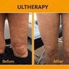 Image 6: Ultherapy Prime Treatment with for Face, Neck and Chest 