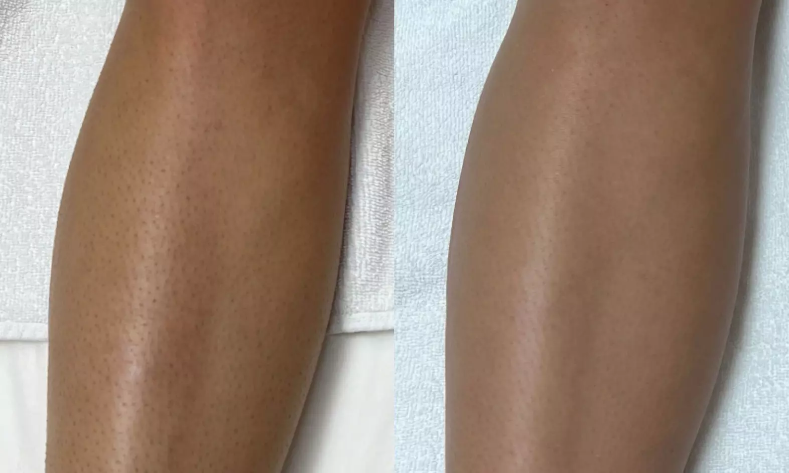 Effortless Smoothness with 3 or 6 Laser Hair-Removal Sessions on Small, Medium or Large Area (Up to 84%Off)