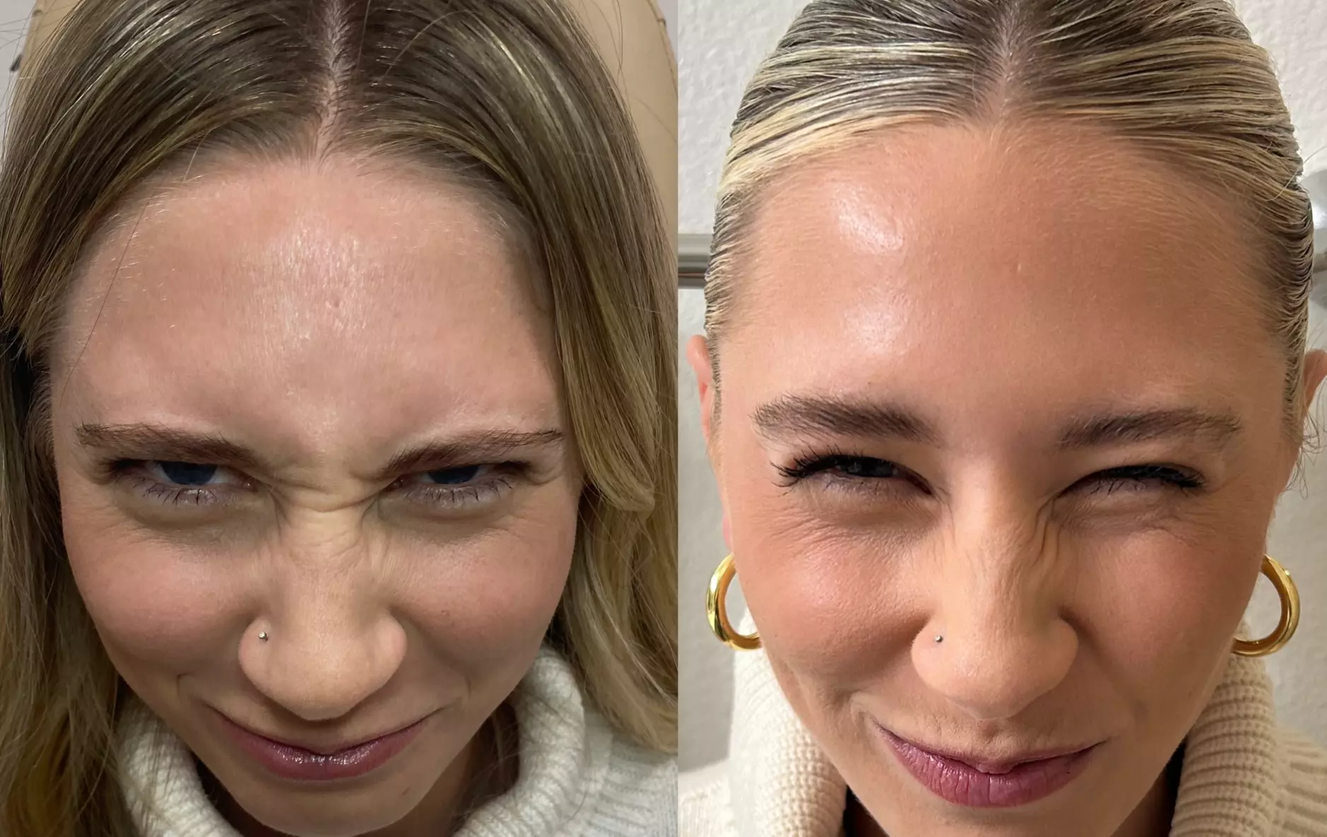 Smooth Away Wrinkles with 20, 40 or 60 Units of Xeomin