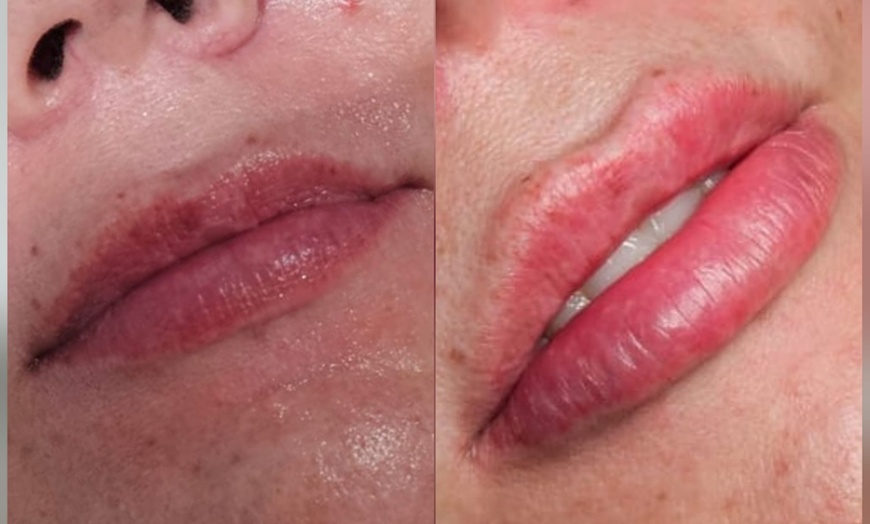 Image 3: Choice of Dermal Filler, Nasolabial Folds, or Marionette Folds (1.1ml)