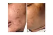 Turn Back Time with the Power of BioRePeel at Rise Skin Spa (Up to 45% Off)
 - Second Medium