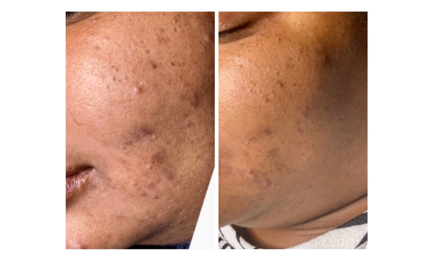 Image 4: Turn Back Time with the Power of BioRePeel at Rise Skin Spa