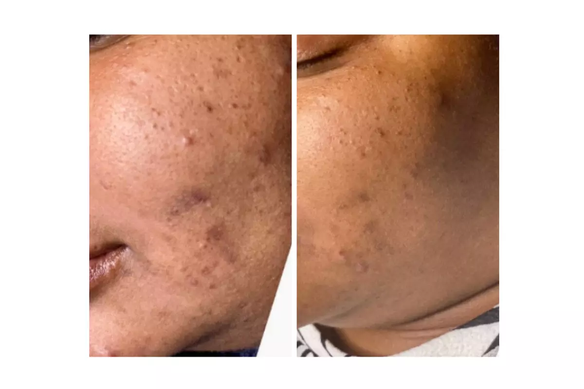 Turn Back Time with the Power of BioRePeel at Rise Skin Spa