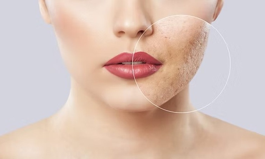 Image 1: Up to 56% Off on Vampire PRP Facelift at Marjan Spa