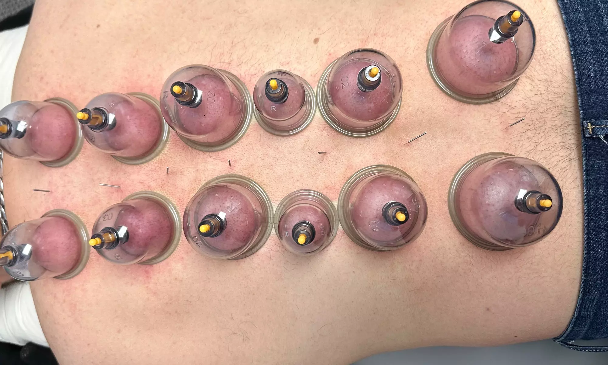 Up to 69% Off on Traditional Chinese Medicine at CFP Acupuncture - Primary Image