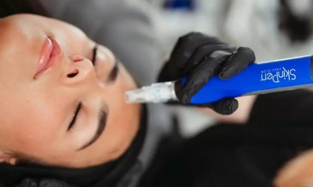 Up to 51% Off on Micro-Needling at Blossom Aesthetics