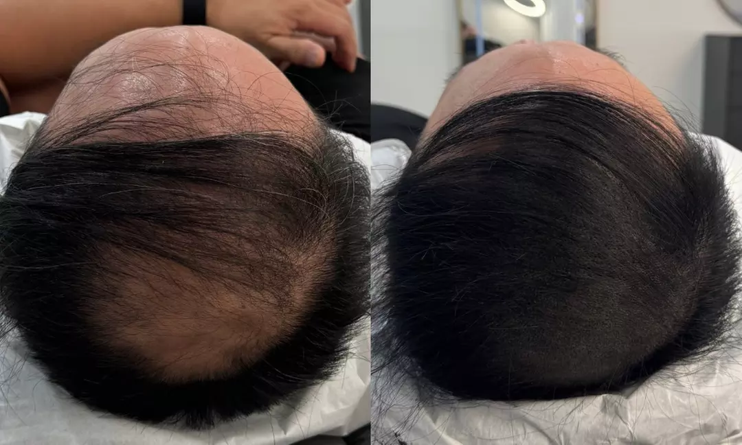 Scalp Micropigmentation: Men’s Hairline (One Session)