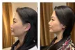 Up to 58% Off on Facelift - Non-Surgical at Your Sculpt Studio - Second Medium