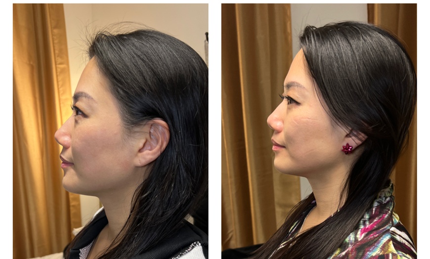 Image 4: Up to 62% Off on Facelift - Non-Surgical at Your Sculpt Studio