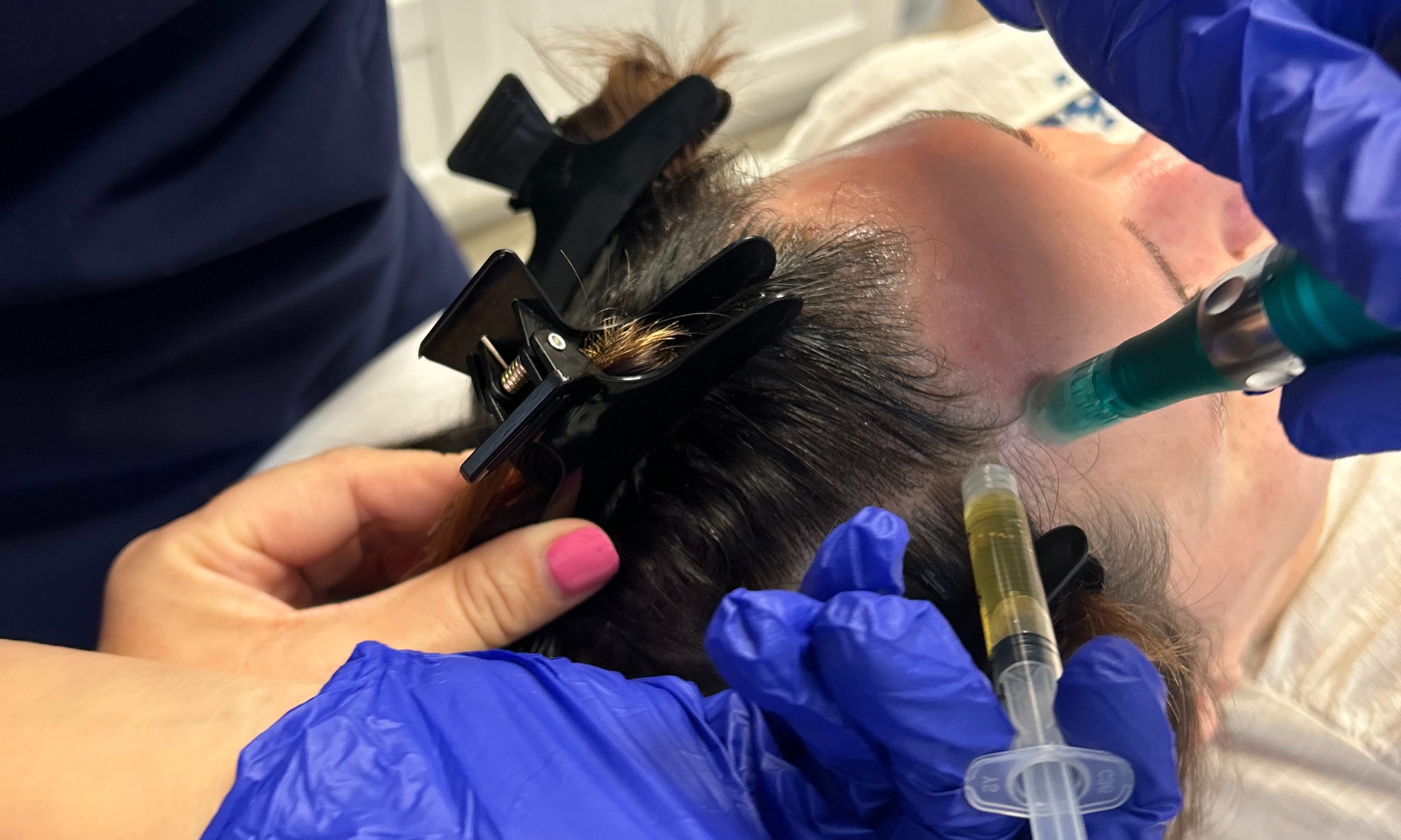 Up to 45% Off on Hair Restoration - Non-Surgical at Holistic Health and Medical