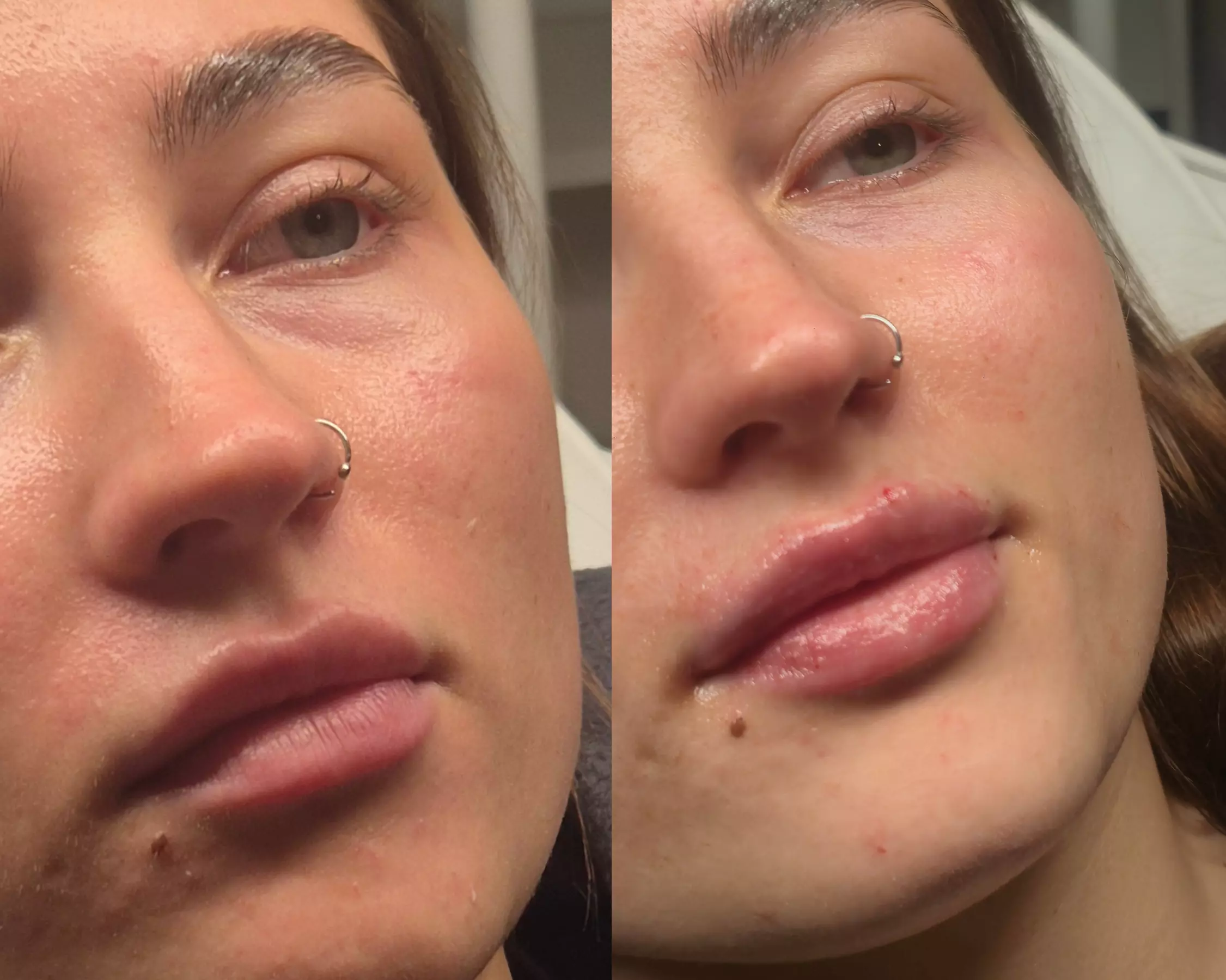 Dermal Filler Treatments to Enhance & Define Facial Features