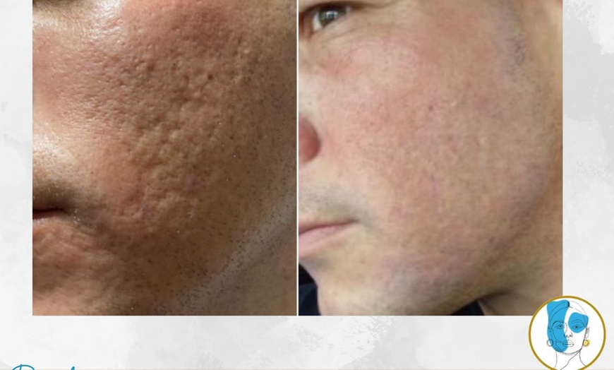 Image 2: Get Two, Four or Six Radio-Frequency Microneedling Treatment 