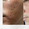 Image 2: Get Two, Four or Six Radio-Frequency Microneedling Treatment 