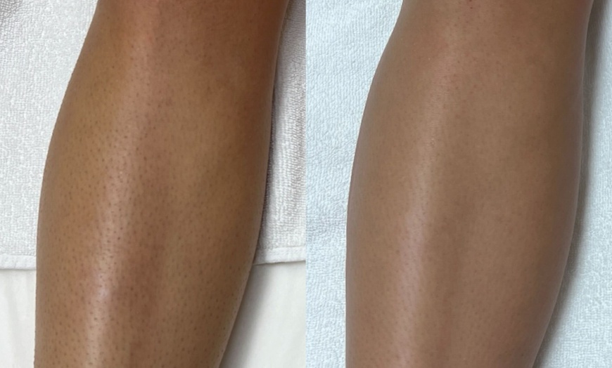 Image 4: Up to 50% Off on Laser Hair Removal at Laser By Nicole Boca Raton