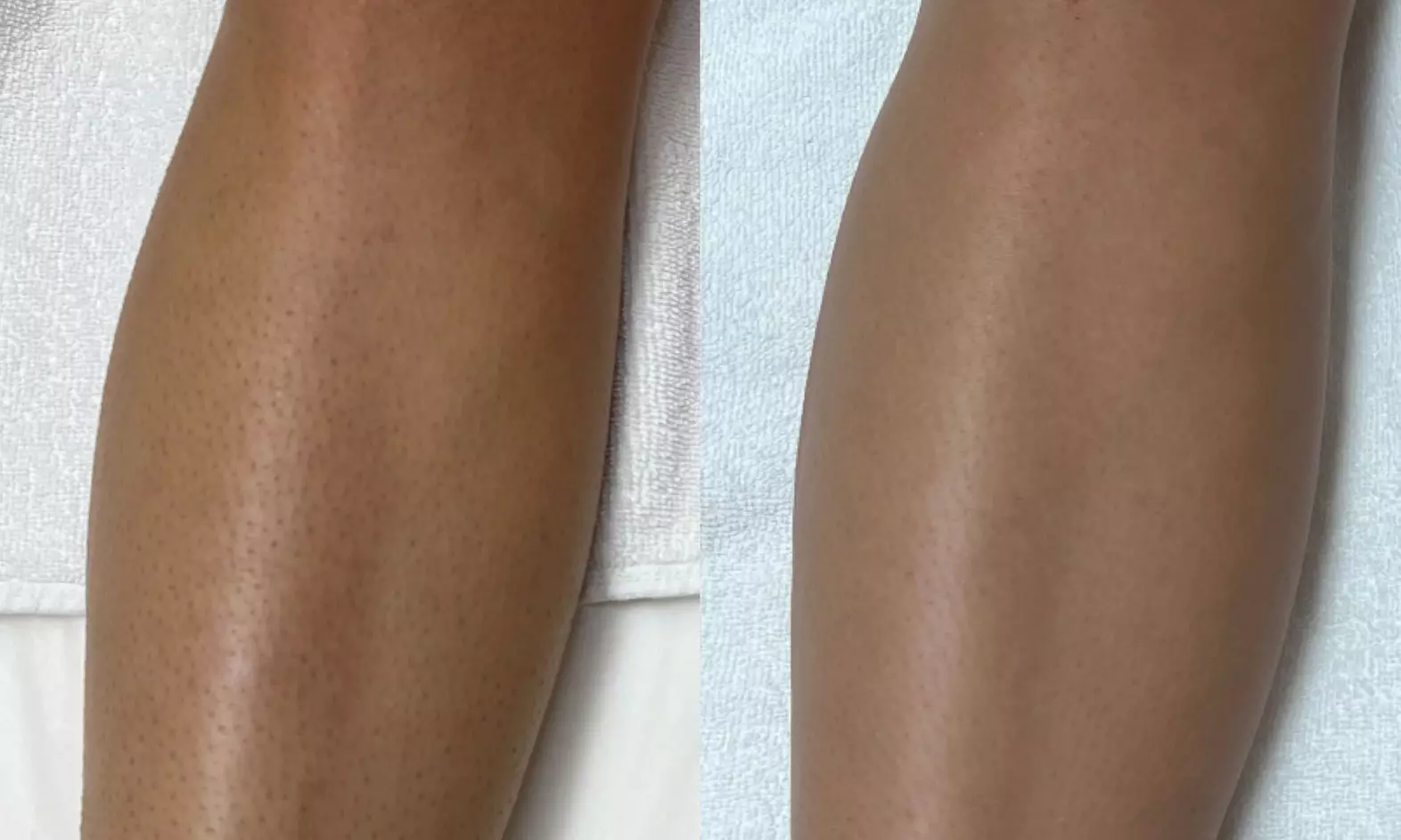 Up to 50% Off on Laser Hair Removal at Laser By Nicole Boca Raton - Second Medium