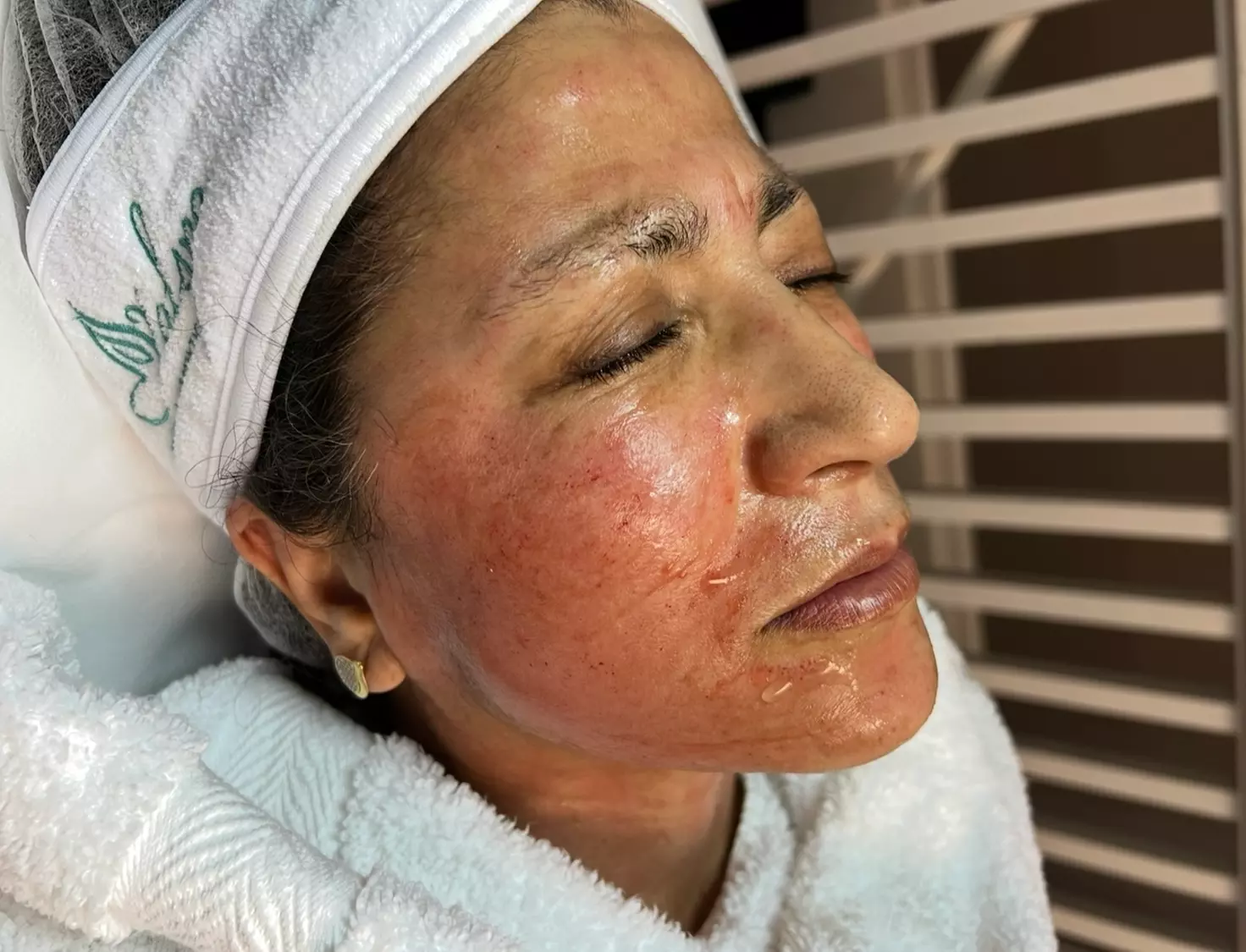 Up to 45% Off on Micro-Needling at Valspa Beauty and Aesthetics