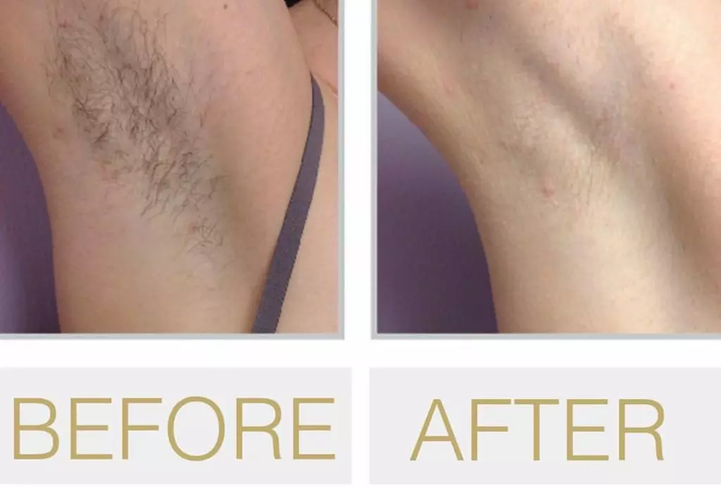 Up to 61% Off on Soprano Laser Hair Removal at Forever Laser - Second Medium