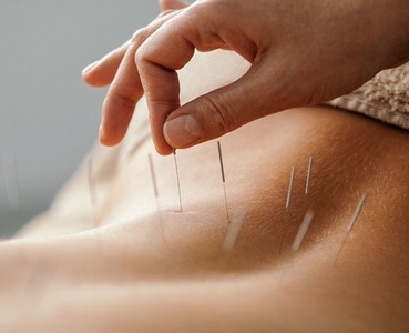 Trigger Point Therapy with Dry Needling One Region Four Sessions - Gravity Spine & Wellness