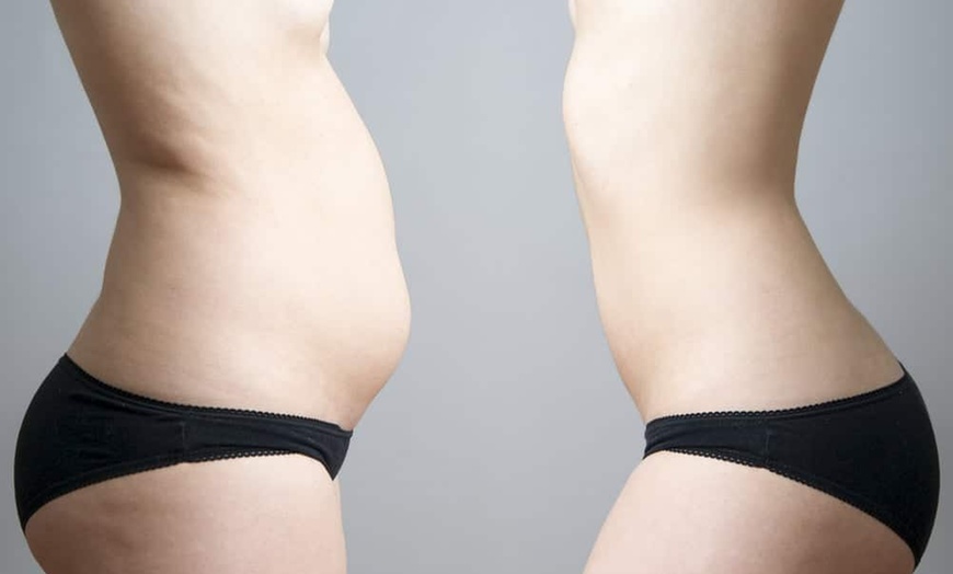 Image 1: Up to 77% Off Laser Lipo & Cavitation Packages JR Astoria Nails & Spa
