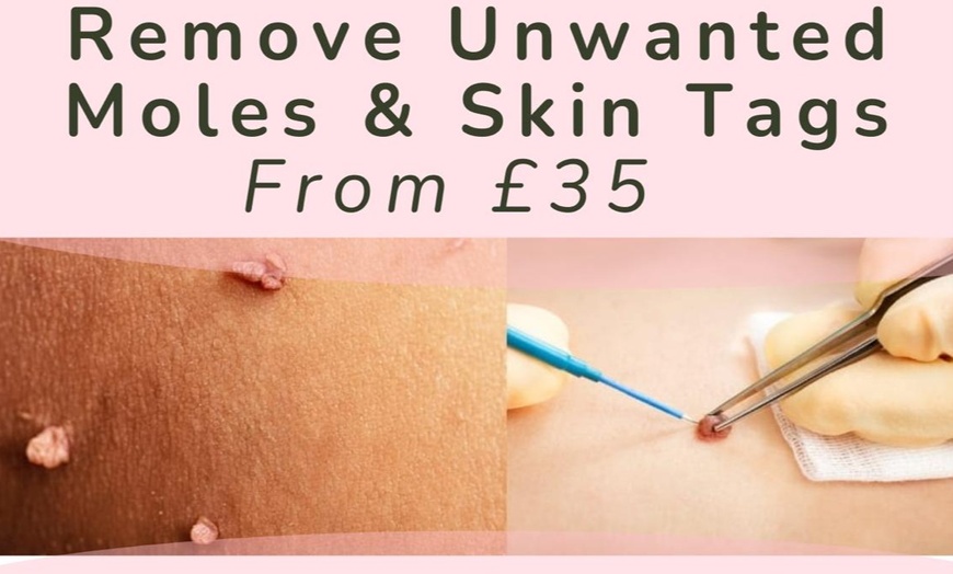 Image 1: Efficient Mole Removal & 15 Min Skin Tag Treatment + Laser Precision