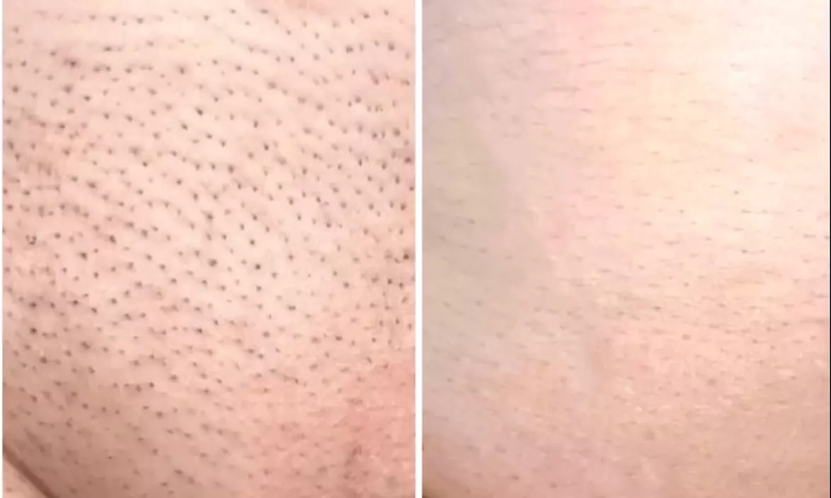 Do 50% zniżki na Depilacja laserowa w Kosmetologia estetyczna - depilacja laserowa