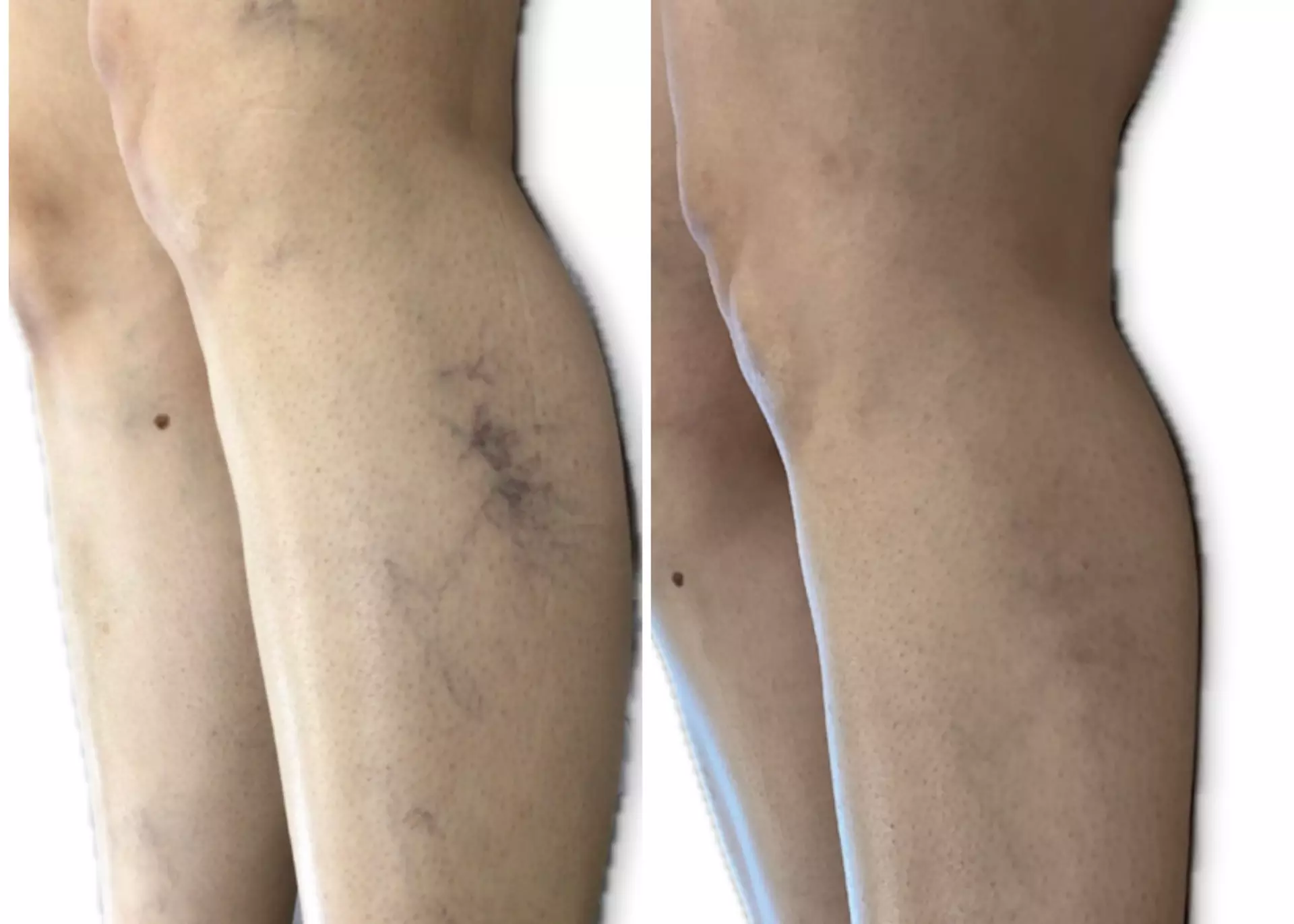 One or Two: Spider Vein Treatments with Complimentary Consultation