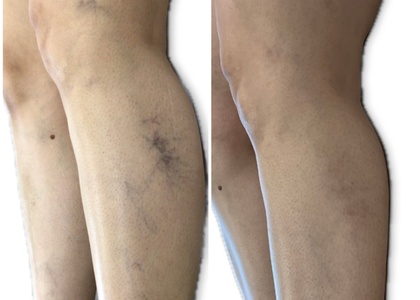 One Spider Vein Treatment for a 4x4 Area with Complimentary Vein Consultation with Provider - Intoxicated Injectables