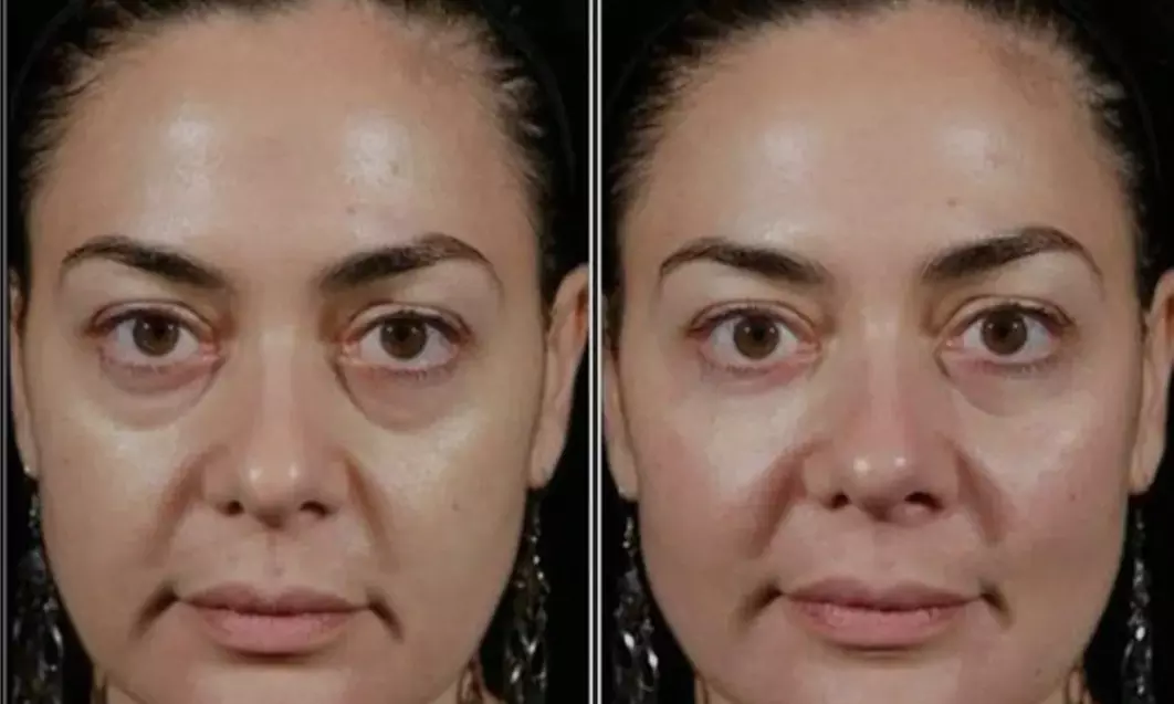 Up to 60% Off on Facial - HydraFacial at Fida Aesthetic - Aesthetic Boutique