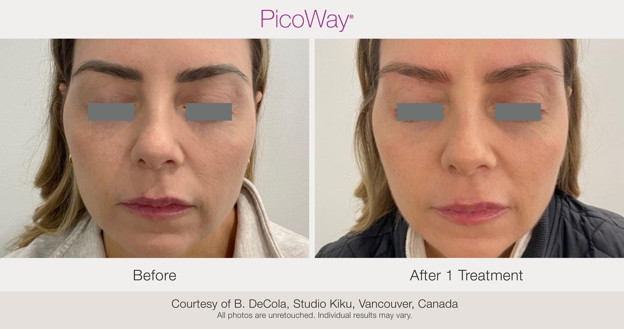 Up to 74% Off  on Picoway Skin Resurfacing