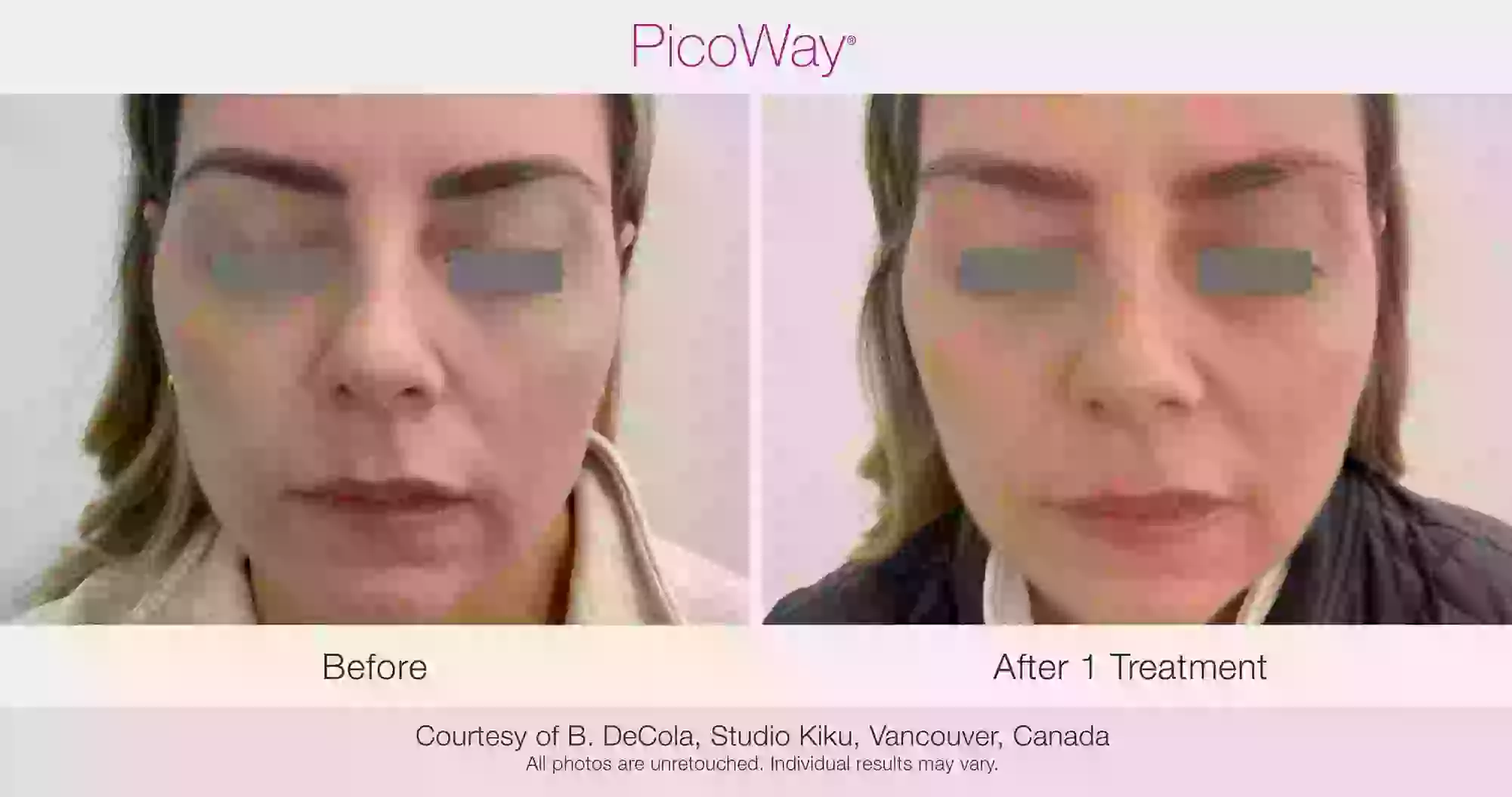 Up to 72% Off on Picoway Skin Resurfacing at AquaVita Wellness & Medspa - Primary Image