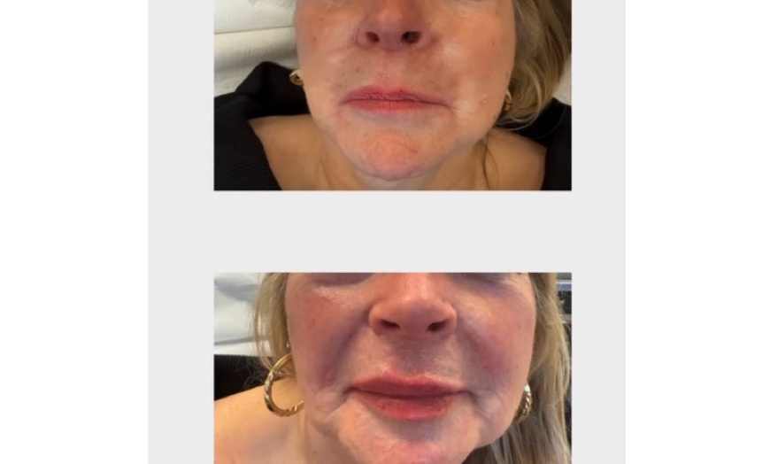 Image 4: Up to 68% Off on Injection - Dermal Filler at Lux clinic Knightsbridge