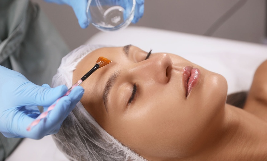 Image 2: 1 or 2 Sessions of (Mandelic Acid) or 1 Session (TCA) Chemical Peel 