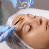 Image 2: 1 or 2 Sessions of (Mandelic Acid) or 1 Session (TCA) Chemical Peel 