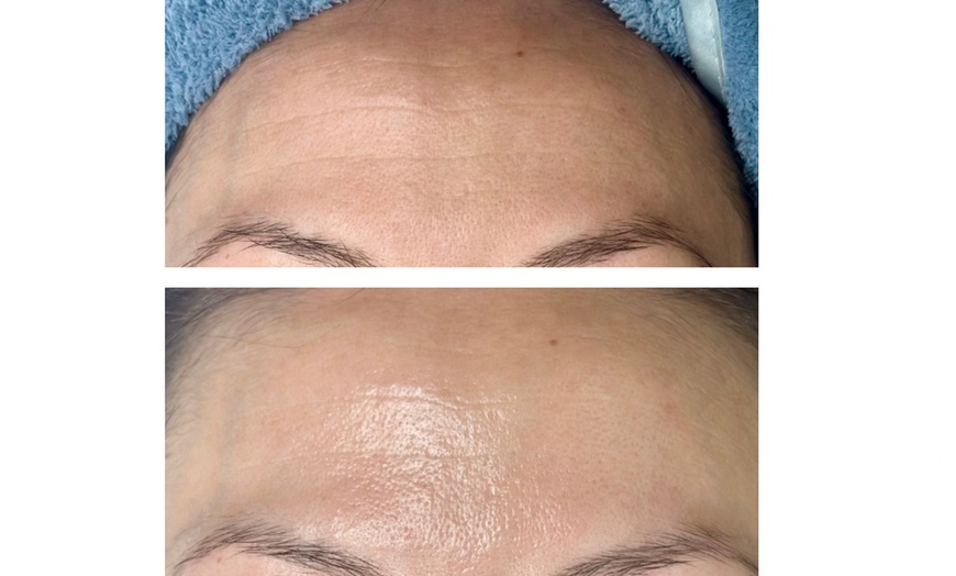 Image 2: Glow + Sculpt: The Ultimate Hydraglow Microdermabrasion