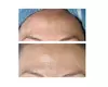 Glow + Sculpt: The Ultimate Hydraglow Microdermabrasion at Rise Skin Spa (Up to 45% Off )
