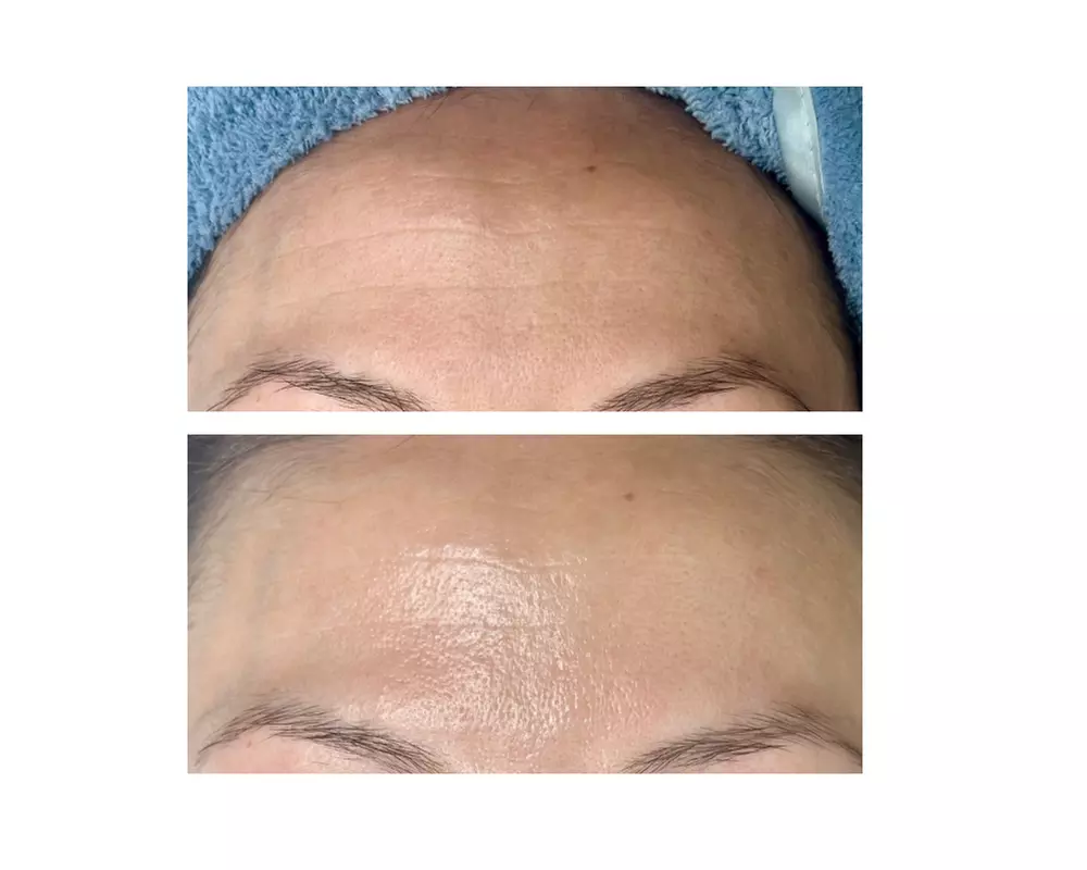 Glow + Sculpt: The Ultimate Hydraglow Microdermabrasion at Rise Skin Spa (Up to 45% Off ) - Primary Image