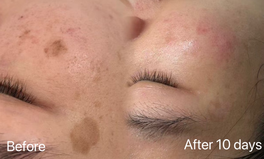 Image 1: One or Three Pico Laser Session for Up to 0.5" x 0.5" or 1" x 1"